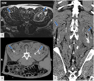 Case Report: Unable to Jump Like a Kangaroo Due to Myositis Ossificans Circumscripta